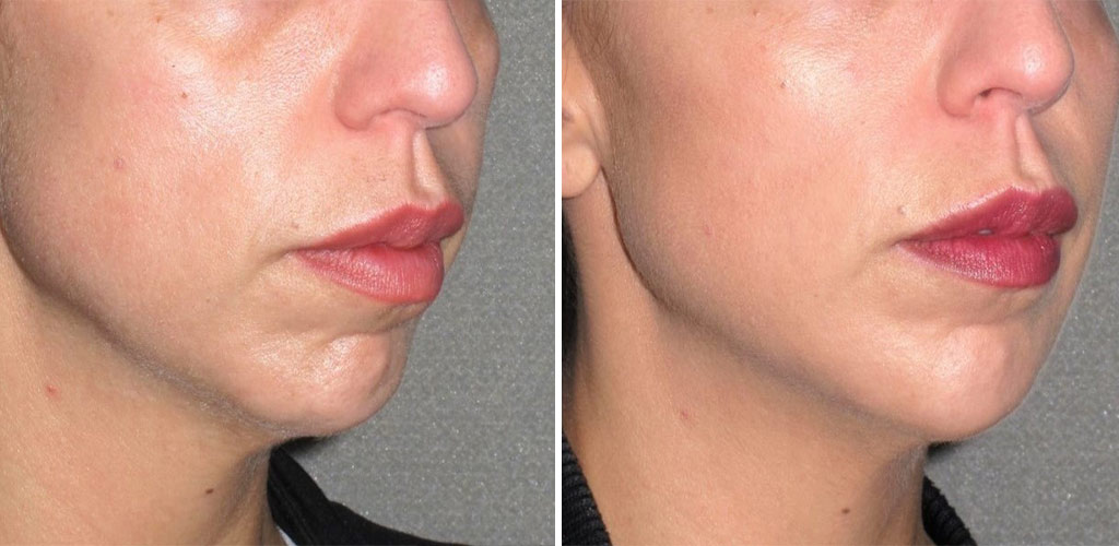 How to get better jawline